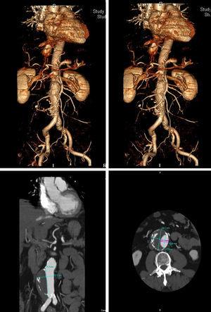 TC angiografía: ateromatosis calcificada de arterias coronarias (imagen superior). Elongación y ateromatosis calcificada aortoiliaca. Aneurisma de aorta abdominal infrarrenal parcialmente trombosado, origen en arterias renales y que se extiende hasta bifuración aortoiliaca (imagen inferior).