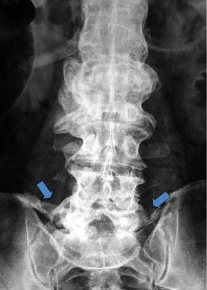 Radiografía anteroposterior de columna lumbar con osificación exuberante en los cuerpos vertebrales desde L1 a L5 y de los ligamentos iliolumbares (flechas). Las articulaciones sacroilíacas presentan espacio articular conservado, sin signos de sacroileítis.