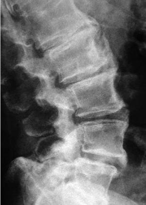 Radiografía lateral de columna lumbar que muestra gruesas calcificaciones vertebrales con espacios discales intersomáticos preservados, en relación con hiperostosis idiopática difusa.