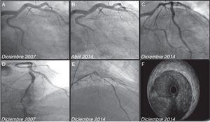 Síndrome Coronario Agudo De Repetición: Lo Que La Coronariografía ...
