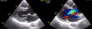 Dilatación de la raíz aórtica junto con la insuficiencia aórtica severa y flap intimal en la aorta descendente.