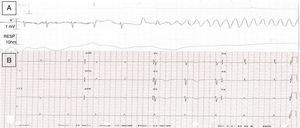 1A Electrocardiograma (ECG) durante síntomas con inicio de la TVS helicoidal a 250lpm. 1B ECG posterior al episodio con ritmo sinusal a 60lpm y QTc de 570mseg.