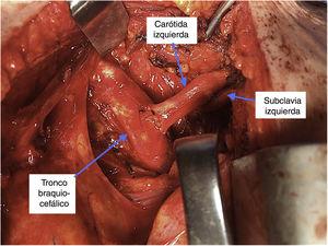 Cirugía híbrida zona 1: traslocación de carótida y subclavia izquierdas.