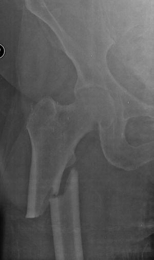Radiograph of a case of subtrochanteric femoral fracture.