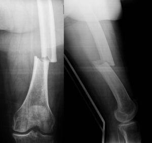 Radiograph of a case of diaphyseal femoral fracture.