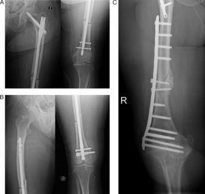 (A) Diaphyseal femoral fracture treated by long, antegrade nailing. (B) Diaphyseal femoral fracture treated by retrograde, intramedullary nailing. (C) Diaphyseal femoral fracture treated by angular stability plate.