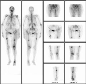 Bone scintigraphy scan marked with technetium showing hyperuptake at the diaphyseal level.
