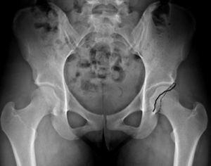 Acetabular retroversion: the anterior acetabular wall projects laterally to the posterior wall (crosslinking sign) in a well-centred anteroposterior projection of the pelvis.