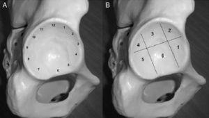Acetabular areas describing the location of the lesions. (A) The classical, clockwise description. (B) Description by geographical area. Both examples show a right hip.