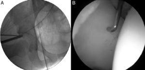 (A) Image of an intraoperative radiograph with the arthroscopic probe showing the area of acetabular overcoverage-retroversion. (B) Arthroscopic view showing the relationship of the same probe with the area of chondral delamination.