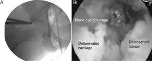 High-speed drilling of the overcoverage area. (A) Intraoperative radiograph. (B) Arthroscopic view.