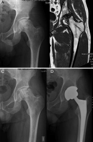 Ficat II extensive femoral head necrosis in a 36-year-old patient. Preoperative anteroposterior radiograph (A) and MRI scan (B) of the left hip. Evolution towards collapse at 23 months (C) and rescue with a total hip arthroplasty (D).