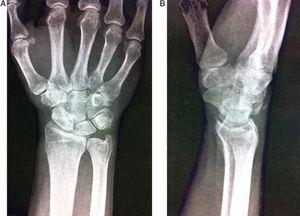 (A and B) Radiographic image at 18 months.