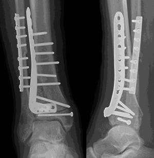 Anteroposterior and lateral view of a tibial plafond fracture treated through open reduction and osteosynthesis with an anterolateral plate.