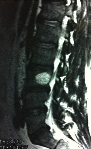 Magnetic resonance imaging (MRI) scan showing Schmorl hernias at the L3 level in the patient with a history of trauma.