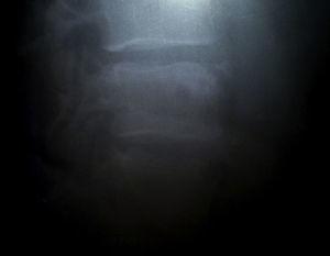 Radiograph showing lack of detachment or solution of continuity in the upper vertebral apex at the L4 level.