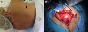 Clinical (A) and surgical (B) images of elastofibroma dorsi.
