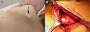 Clinical (A) and surgical (B) images of scapular osteochondroma.