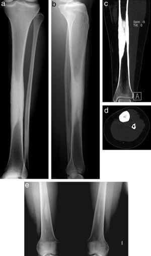 Simple radiograph of the left tibia. Fusiform diaphyseal endosteal and periosteal sclerosis sparing the metaphysis and epiphysis could be seen, with another similar lesion in the distal fibula (a, b). The computer-assisted tomography image revealed that the lesion obstructed the intramedullary canal (c, d). The bone scintigraphy series revealed smaller, asymptomatic sclerotic intramedullary lesions in these locations (e).
