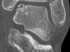 Grade IV osteochondral lesion of the talus in an anteromedial angle. Plain radiography is the first imaging test to be considered in the diagnosis of osteochondral lesions.