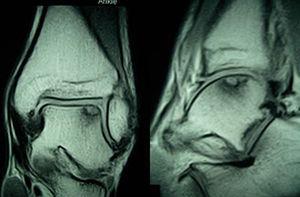 Grade II osteochondral lesion. The MRI scan shows the lesion in an anterolateral angle with subchondral bone edema and integrity of the articular surface.