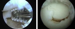 Debridement of the osteochondral lesion and reconstruction of the defect with an osteochondral plug in a grade IV medial lesion.