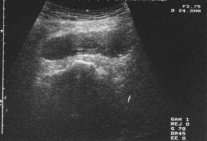 Ultrasound scan performed to guide the suspected diagnosis of massive hematoma.