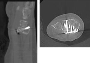Images from the CT study compared with Rx using supports. It is possible to confirm the slight dorsal protrusion observed in Fig. 2.
