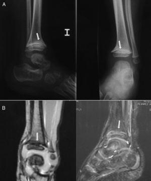 Case 2: a 2-year-old boy who developed a central bone bridge in the distal tibia after Salter–Harris type II epiphysiolysis 6 months earlier. Plain radiographs (A) suggested the presence of a central partial physeal arrest (arrows), which was confirmed by MRI (B). This lesion caused a mild varus angular deformity and length discrepancy of 5mm.