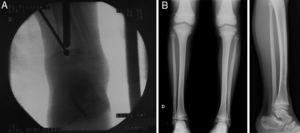 Case 2: the previous injury was treated through arthroscopically assisted resection 9 months after the initial injury. (A) Intraoperative fluoroscopic image showing the simultaneous use of a high-speed mill and arthroscope. (B) Simple radiograph obtained after 5 years follow-up showing a correct alignment without length discrepancy.