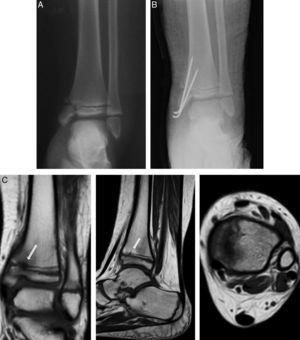Case 3: an 8-year-old girl who suffered a fall resulting in type IV epiphysiolysis in the distal tibia (A). We performed osteosynthesis using Kirschner wires (B). At 7 months of the lesion, MRI (C) identified an elongated partial bony bridge in the distal medial tibia which caused varus deformity.