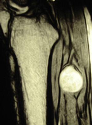 MRI scan showing a round lesion close to the posterior tibial nerve.