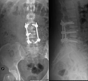 Postoperative lumbar Rx. AP and lateral projections.