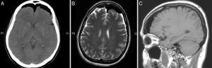 (A) Cranial CT; axial section. (B) Cranial MRI; T2 axial section. (C) Cranial MRI; T1 sagittal section.