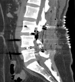 Lumbar spinal CT; sagittal section.