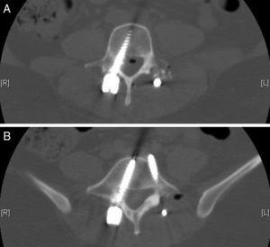 Lumbar CT; axial section; right L4 (A) and L5 (B) screws.