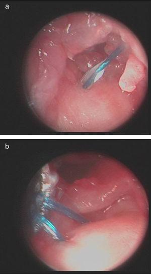 (a) and (b) Arthroscopic images of the surgical technique. Passage of the 3/0 monofilament thread through the torn fibrocartilage following the outside-in technique.