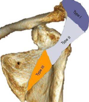 Classification of fractures of the acromion according to Levy et al.16.