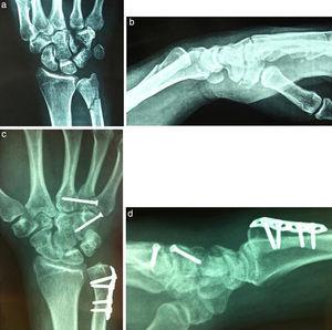 Longitudinal fracture of the hamate body, dislocation of the base of the 4th metacarpal and fracture of the ulna. (a) Anteroposterior projection. (b) Lateral projection. (c) Radiographic control after 1 year, with anteroposterior projection showing consolidation of the fractures of the ulna and hamate body and reduction of the base of the 4th metacarpal. (d) Lateral projection of case number 1.