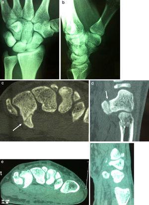 Fracture of the hamate hook. (a) Anteroposterior projection, (b) and lateral projection, with no visible fracture. CT axial projection, (c) and sagittal projection, (d) showing the fracture of the hamate hook. Current CT images after the excision, axial projection (e) and sagittal projection (f) of case number 2.