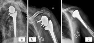 Complication due to loosening of the metaglene. (a) Radiograph at 3 months after the surgery, observing an initial onset of notching. (b) Grade 4 notching. (c) Radiograph at 8 months after the reconversion to hemiarthroplasty.
