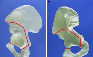 Paths of the osteotomies according to the Ganz technique. (A) Lateral view of the incision in the hemipelvis. (B) Medial view of the incision in the hemipelvis.