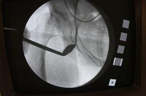 Intraoperative fluoroscopic control whilst performing osteotomy in the ischium.