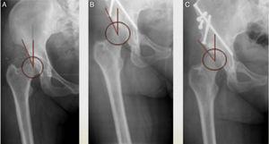 Radiographic evolution of the Wiberg angle. (A) Preoperative. (B) One year after the surgery. (C) Five years after the surgery.