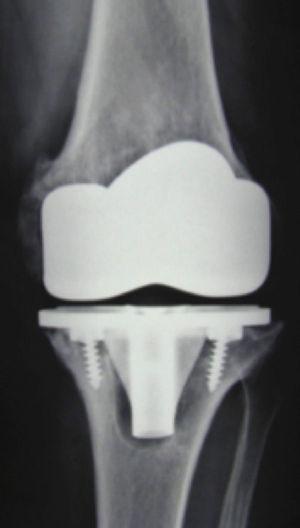 X-ray image of septic loosening. Note the cystic cavity around the tibia.