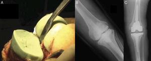 2-stage replacement with a hand-shaped cement articulated spacer. (A) Image during surgery. (B) X-ray image after surgery. (C) X-ray check after re-implantation.