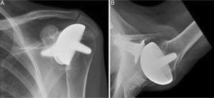 Left shoulder X-rays of a 45 year-old woman (juvenile rheumatoid arthritis), (A) anteroposterior and (B) axillary, showing total Copeland® resurfacing arthroplasty of the shoulder prior to revision surgery due to secondary breakage of the rotator cuff and loosening of the glenoid component.
