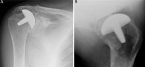 X-rays of the right shoulder of a 58 year-old man in anteroposterior (A) and axillary (B) projections, showing Copeland® resurfacing hemiarthroplasty, prior to revision surgery due to rotator cuff secondary breakage and insufficiency. Figure (A) shows the accentuated rise of the humeral head.