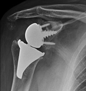Anteroposterior X-ray of the right shoulder taken 12 months after the revision arthroplasty, showing the Verso® total reverse shoulder arthroplasty as the revision implant.