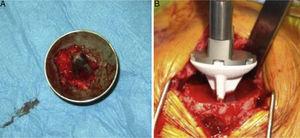(A) Intraoperative clinical photograph showing an upper view of the Copeland mark-3® resurfacing shoulder prosthesis humeral component, in which the good anchorage can be seen together with the spongy bone of the humeral head in the caudal part of the implant, coated in hydroxyapatite. (B) Intraoperative image showing the insertion of the uncemented hydroxyapatite-coated short stem into the humeral metaphysis.